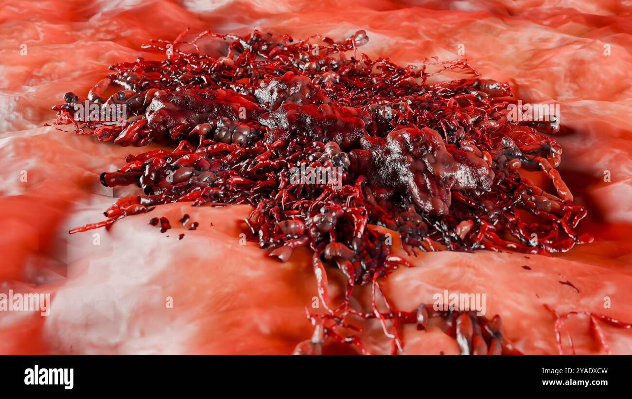 Unkontrolliertes Wachstum von Krebszellen über Gewebe, Tumorinfektionszellen und Ausbreitung, invasive Entzündungsmetastasen krebserregend. Durch Duplikate reproduzieren Stockfoto