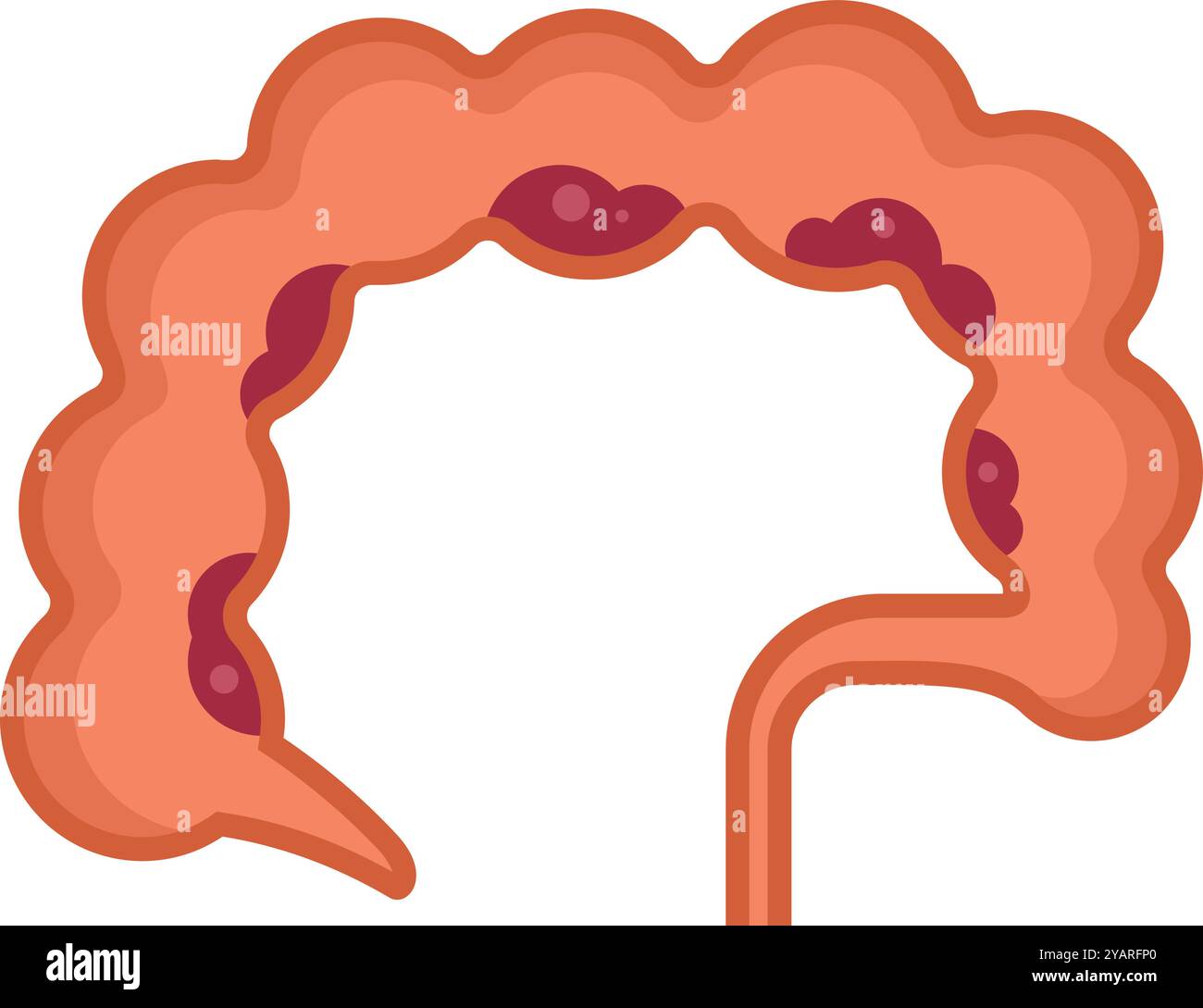 Illustration eines Dickdarms mit Divertikulitis, einer Darmverdauungsstörung Stock Vektor