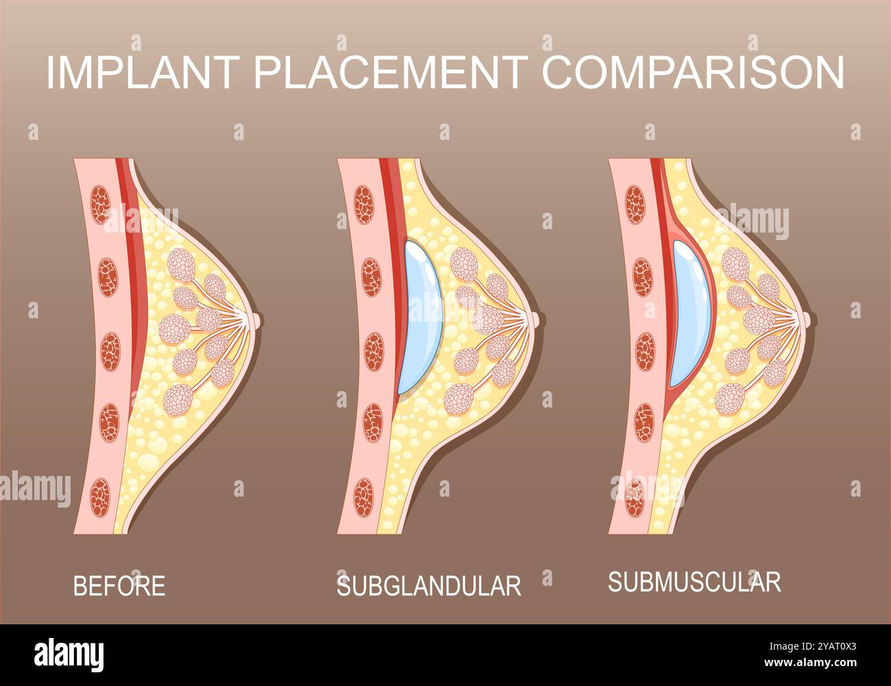 Implantatplatzierung der Brust. Kosmetisch-plastische Chirurgie. Mammaplastik. Mammarekonstruktion. Submuskuläre Tasche unter dem Muskel und subglanduläres Implantat Stock Vektor