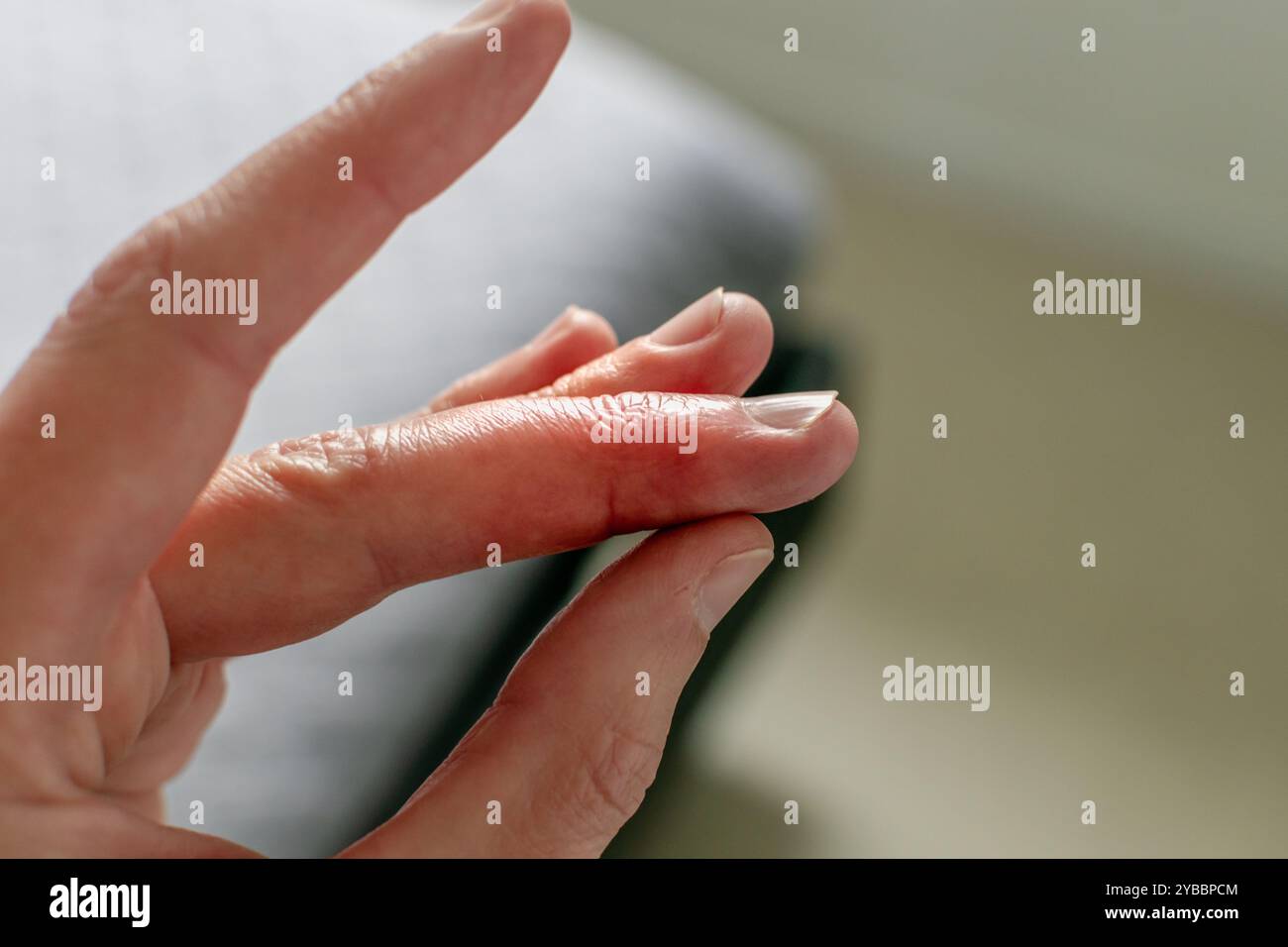 Hammerfingerheilheilung nach Schienenabnahme vom Mittelfinger nach Gelenktrauma Stockfoto