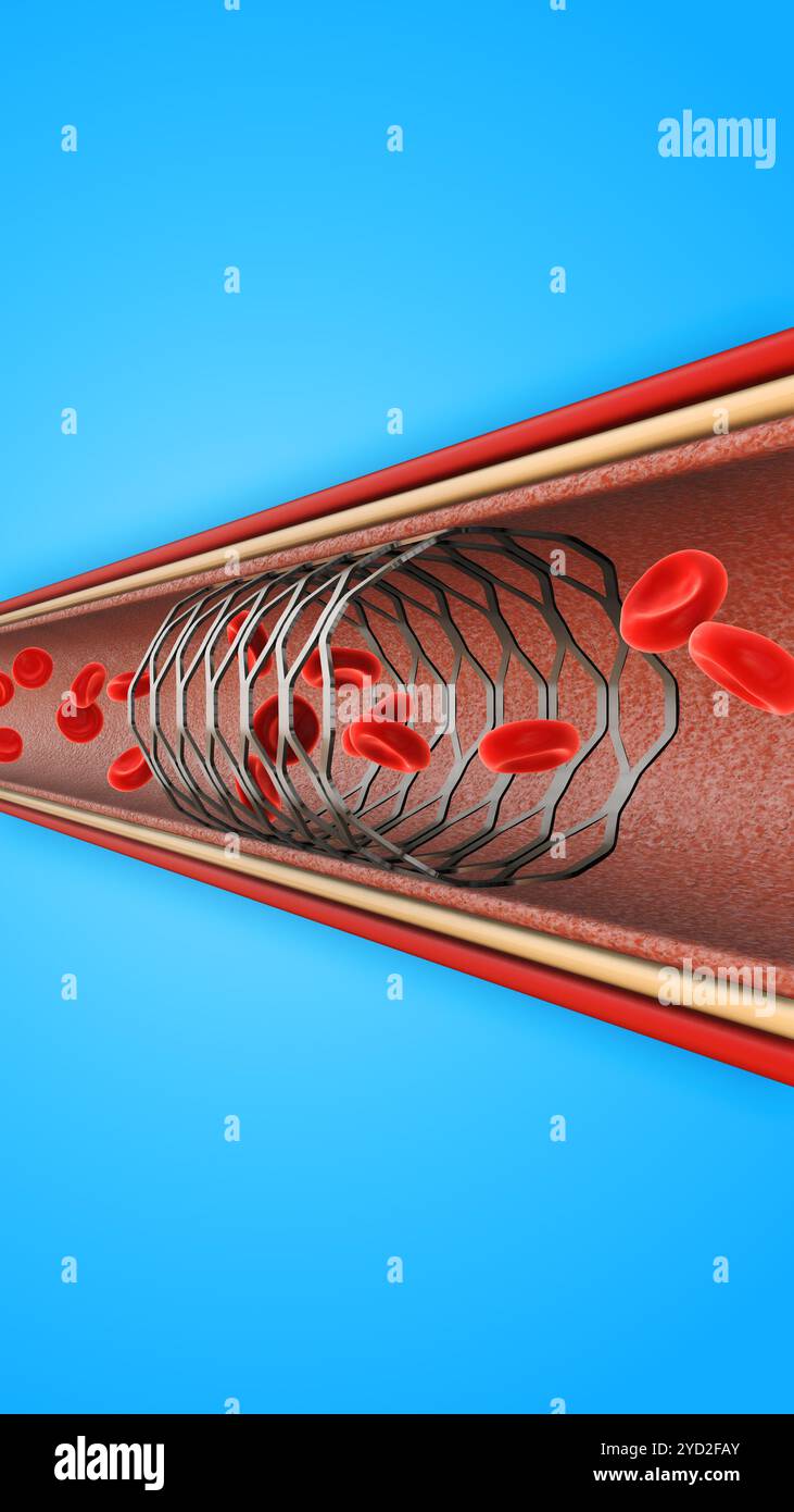 Blutzellen, Die Durch Das Stent-Gefäß Fließen Stockfoto