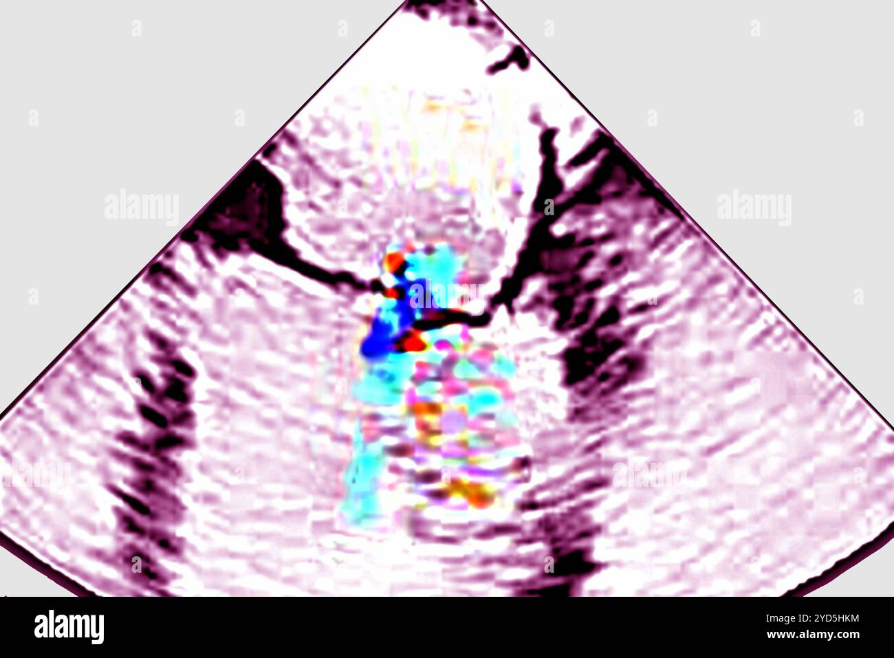 Ischämische Mitralinsuffizienz (MI) - Pathologie des linken Ventrikels (Mitralring und subvalvulärer Apparat). Transthorakale Echokardiographie (TTE). Stockfoto