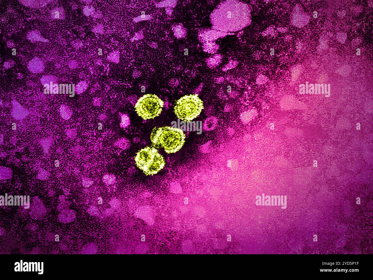 1981 Dr. Erskine Palmer dieser Transmissionselektronenmikrograph (TEM) zeigte das Vorhandensein von Hepatitis-B-Virionen. Stockfoto