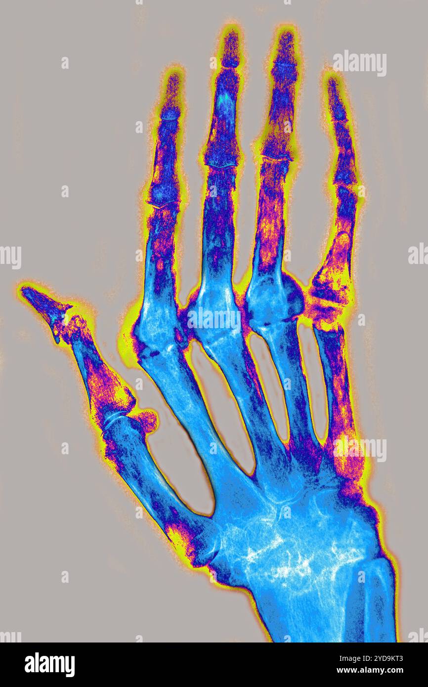 Rheumatoide Arthritis chronische rheumatische Arthritis - chronisch progressive Polyarthritis diese Krankheit ist die Ursache für Ankylose und Knochendeformitäten. Dieser Zustand betrifft vorzugsweise Frauen, er ist für Knorpel-, Knochen- und Bandzerstörung verantwortlich, sein Ursprung ist unbekannt. Die Röntgenaufnahme der Hand. Rheumatoide Arthritis 016836 042 Stockfoto