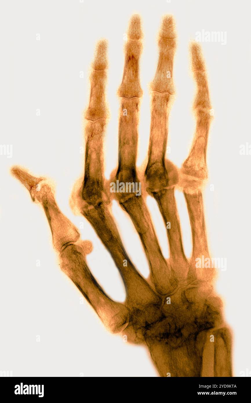 Rheumatoide Arthritis chronische rheumatische Arthritis - chronisch progressive Polyarthritis diese Krankheit ist die Ursache für Ankylose und Knochendeformitäten. Dieser Zustand betrifft vorzugsweise Frauen, er ist für Knorpel-, Knochen- und Bandzerstörung verantwortlich, sein Ursprung ist unbekannt. Die Röntgenaufnahme der Hand. Rheumatoide Arthritis 016836 040 Stockfoto