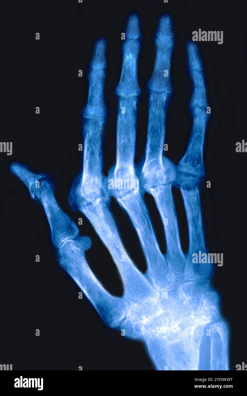 Rheumatoide Arthritis chronische rheumatische Arthritis - chronisch progressive Polyarthritis diese Krankheit ist die Ursache für Ankylose und Knochendeformitäten. Dieser Zustand betrifft vorzugsweise Frauen, er ist für Knorpel-, Knochen- und Bandzerstörung verantwortlich, sein Ursprung ist unbekannt. Die Röntgenaufnahme der Hand. Rheumatoide Arthritis 016836 041 Stockfoto