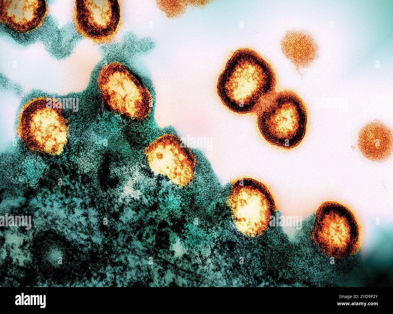 Transmissionselektronenmikrogramm von HIV-1-Viruspartikeln, die orange/gelb gefärbt sind und sich aus einem HIV-infizierten H9-T-Zell-Grün replizieren. HIV-1 Viruspartikel 016867 036 Stockfoto