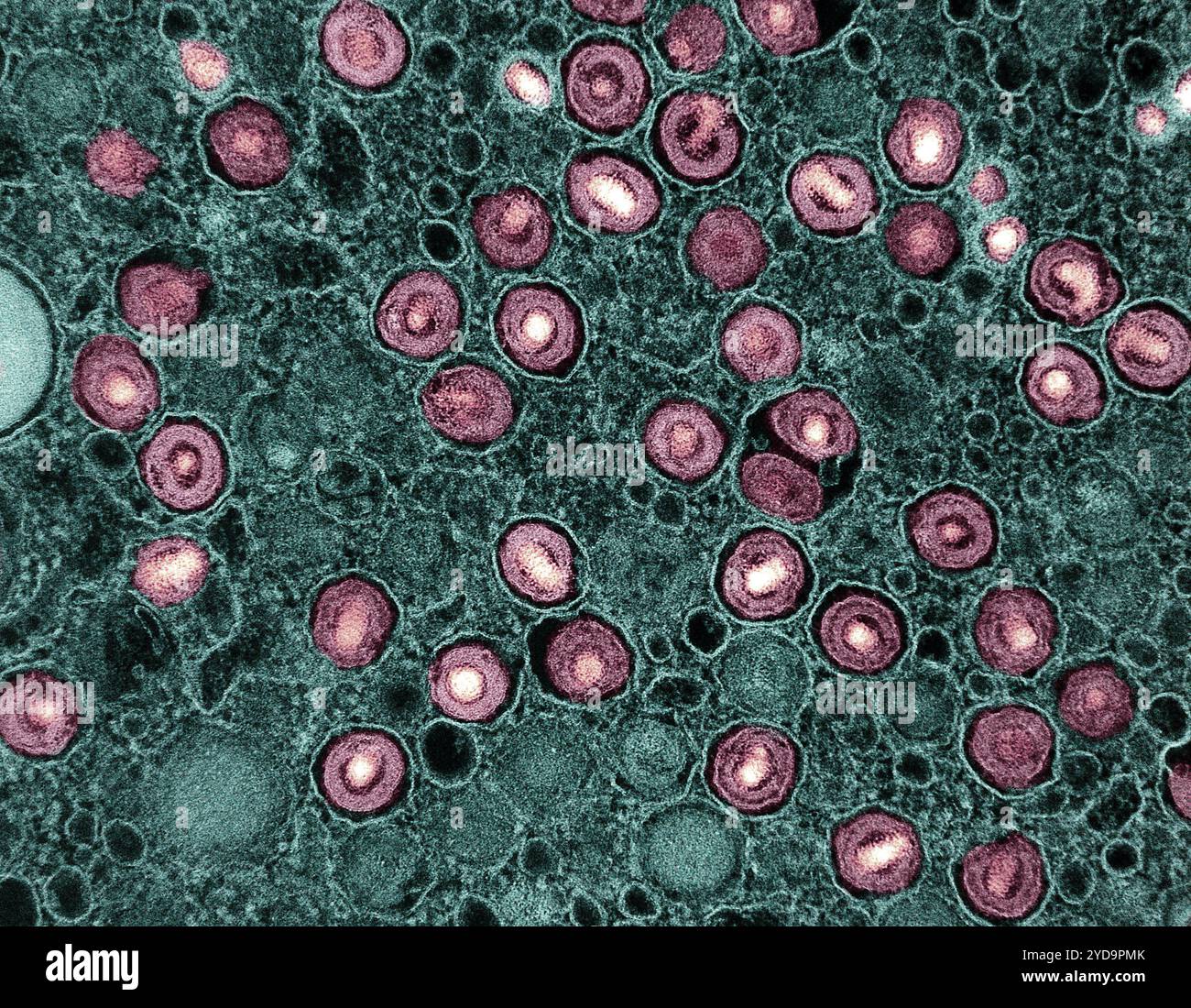 Transmissions-Elektronenmikroskop von Cytomegalievirus CMV-Partikeln rosa in intrazellulären Vesikeln eines infizierten Makrophagen-Teal. Cytomegalievirus CMV Partikel 016867 092 Stockfoto