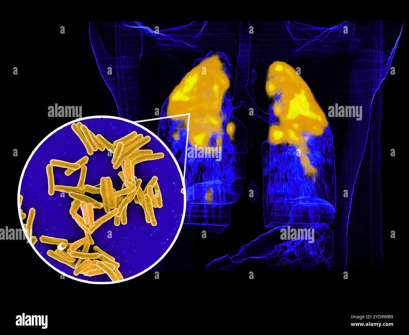 Rasterelektronenmikroskop von Mycobacterium tuberculosis-Bakterien, die TB-kreisförmiges Vordergrundbild verursachen Bakterien sind Gold gefärbt und ein PET/CT-Scan zeigt TB-Infektion Gold und Gelb in einem Lungen-Hintergrundbild des Patienten. Mycobacterium tuberculosis-Bakterien, die Ursache der TB 016867 401 Stockfoto