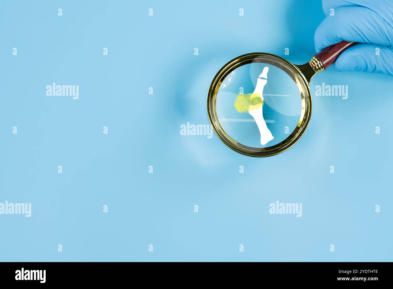 Gicht. Nahaufnahme des Gelenks mit entzündlicher Arthritis. Menschliche Fussskelettknochen durch Vergrößerungsglas isoliert, anteriore Projektion isoliert. Bildung Stockfoto