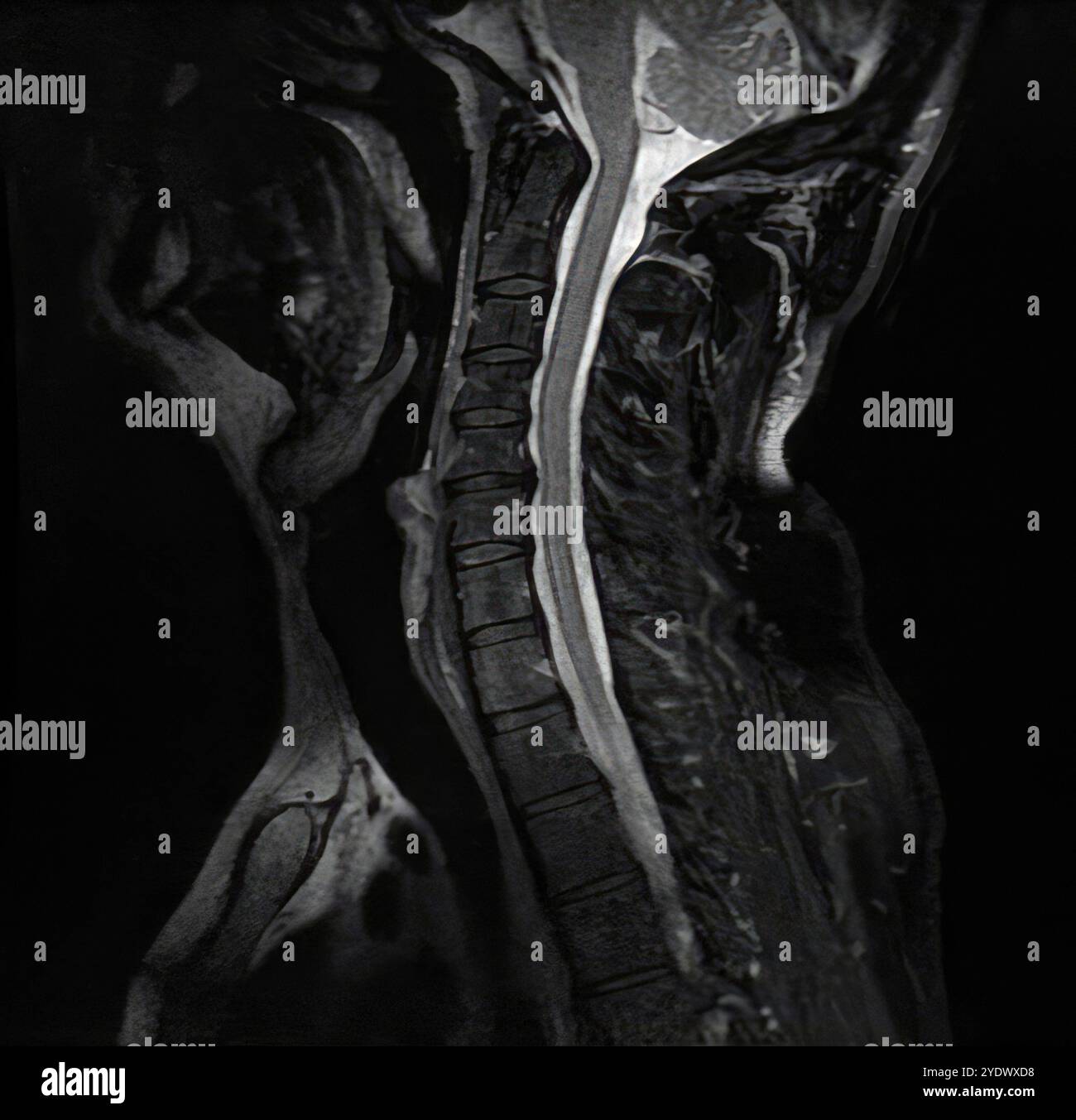 Sagittale mrt-Untersuchung der Halswirbelsäule mit Hervorhebung des Rückenmarks und der umliegenden Weichteile Stockfoto