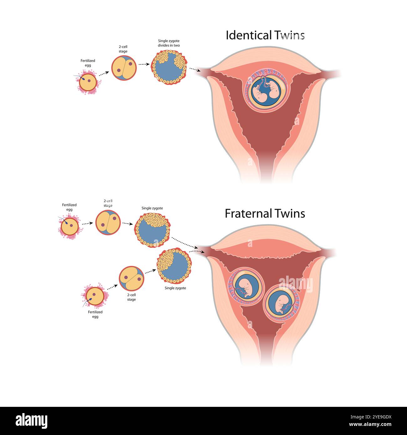 Monozygote (identische) und dizygotische (brüderliche) Zwillinge Stockfoto