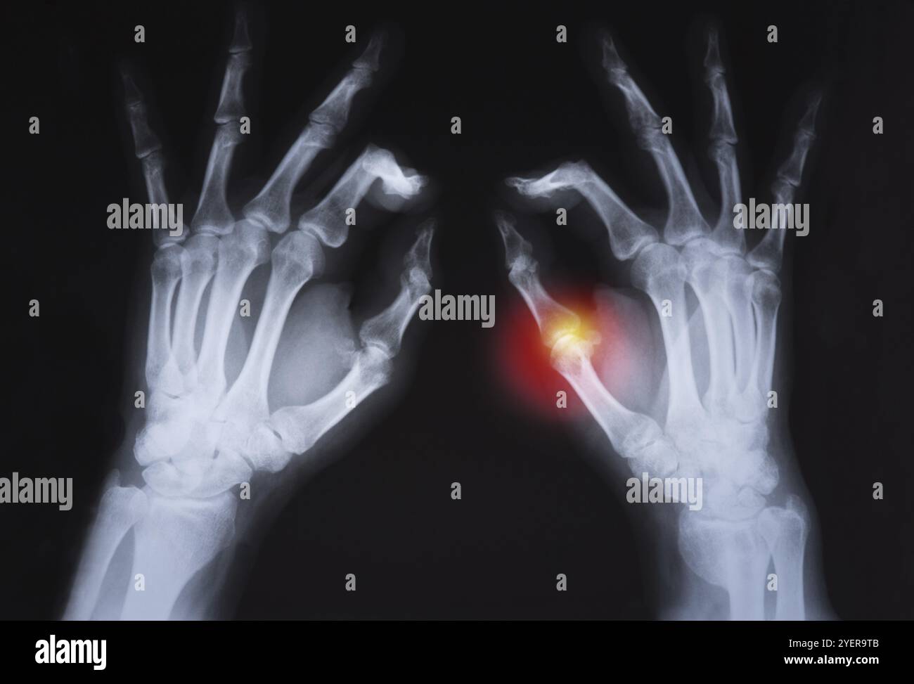 Die menschliche Hand x-ray rot markiert Stockfoto