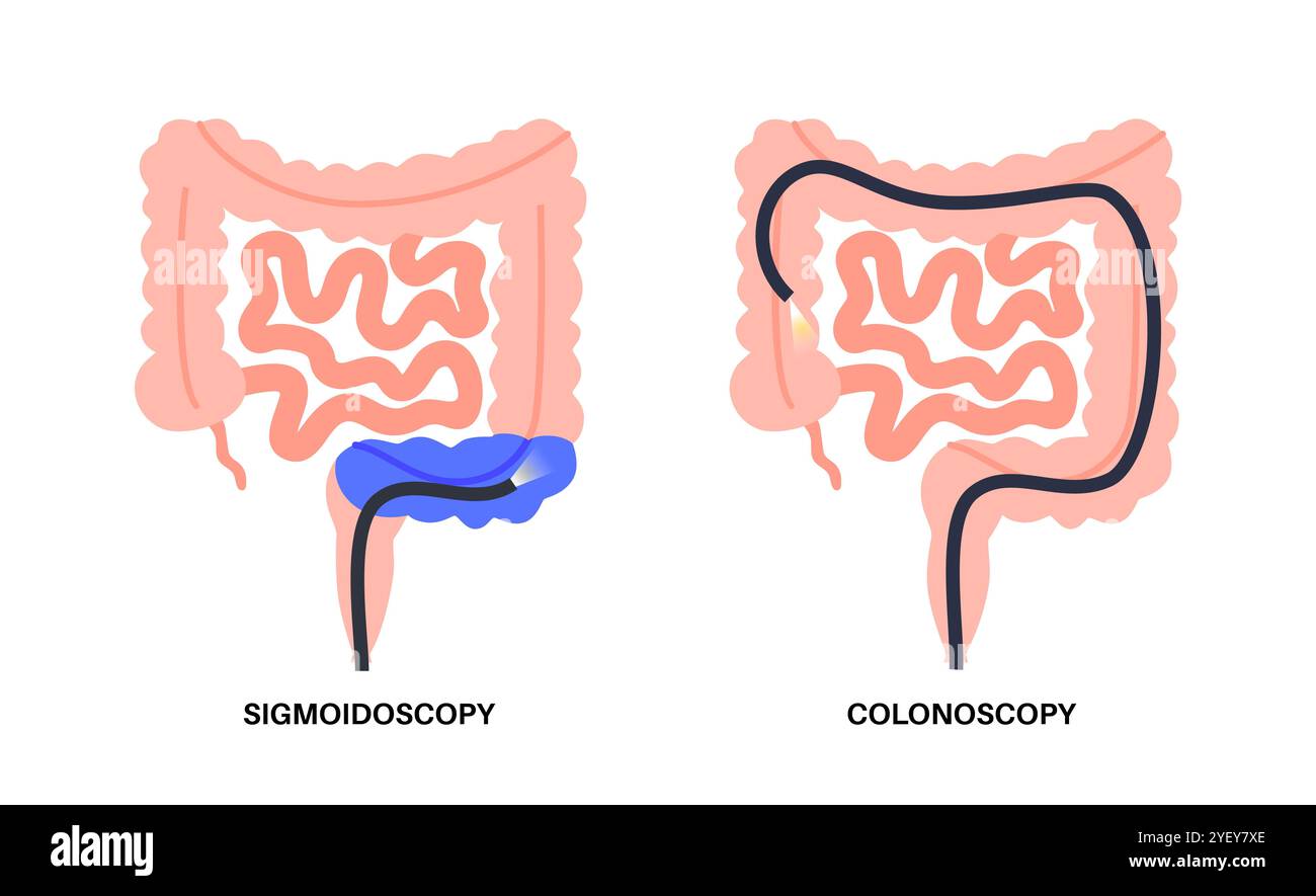 Konzeptionelle Darstellung von Koloskopie- und Sigmoidoskopieverfahren. Bei beiden Verfahren wird nach abnormalen Bereichen im Kolon und Rektum gesucht. Beide verwenden eine dünne flexible Röhre mit Kamera und Licht am Ende, um den Dickdarm zu betrachten. Bei einer Koloskopie wird der gesamte Kolon untersucht, bei einer Sigmoidoskopie wird der Kolon Sigmoid untersucht. Stockfoto