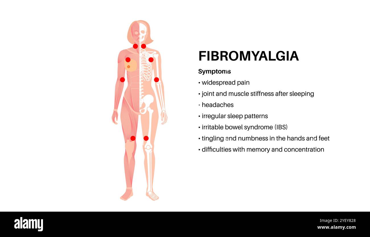 Konzeptuelle Darstellung der Fibromyalgie. Fibromyalgie ist eine chronische Erkrankung, die Schmerzen und Druckempfindlichkeit im ganzen Körper sowie Müdigkeit und Schlafstörungen verursacht. Die genaue Ursache ist unbekannt, wird aber oft durch körperlichen oder psychischen Stress ausgelöst. Stockfoto