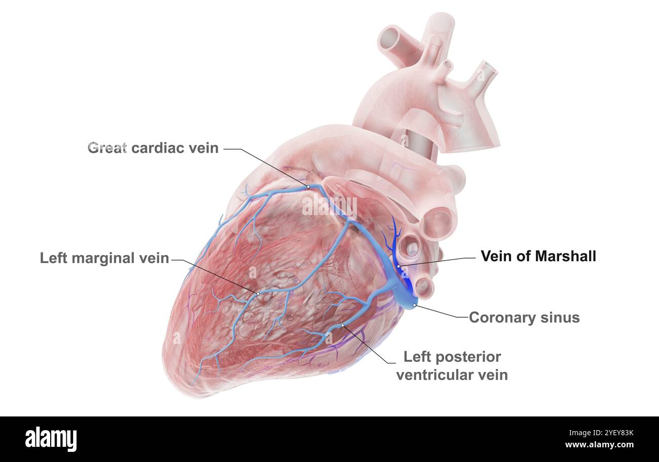 Abbildung der Koronarvenen mit hervorgehobener Marshall-Vene (dunkelblau). Die große Herzvene verläuft über den linken Ventrikel (untere Kammer) des Herzens. Die Vene Marshall, auch bekannt als Vena Vena Vena Vena Vena ventrialis obliquque, ist ein embryologisches Überbleibsel der Vena cava Superior. Es wird angenommen, dass es eine Quelle für Auslöser von Vorhofflimmern (AF) ist, einer unregelmäßigen und oft ungewöhnlich schnellen Herzfrequenz. Eine unbeschriftete Version dieses Bildes finden Sie unter F043/3536. Stockfoto