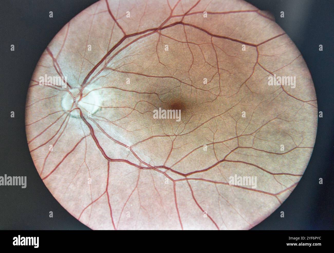 Weitwinkel-Netzhautaufnahme mit ultrahochauflösender Weitfeld-Fundus-Bildgebung. Es ist für die Diagnostik von Netzhauterkrankungen bestimmt. Stockfoto