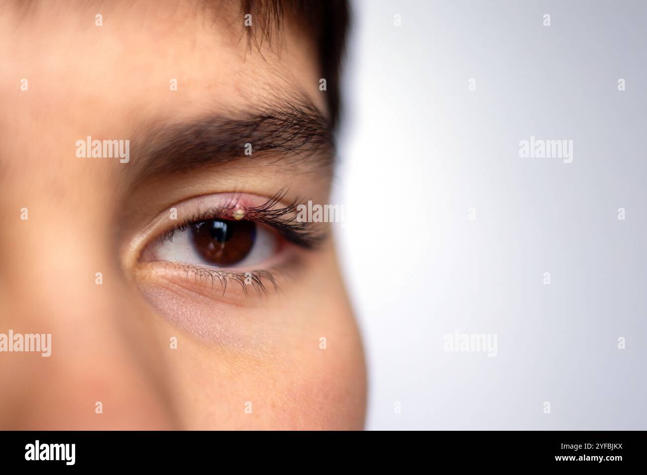 Nahaufnahme eines Jungen-Auges mit kleinem Stich am Oberlid in detaillierter Makroansicht. Geschwollene und irritierte Haut um die Wimpern herum. Gesundheits- und medizinisches Konzept für e Stockfoto