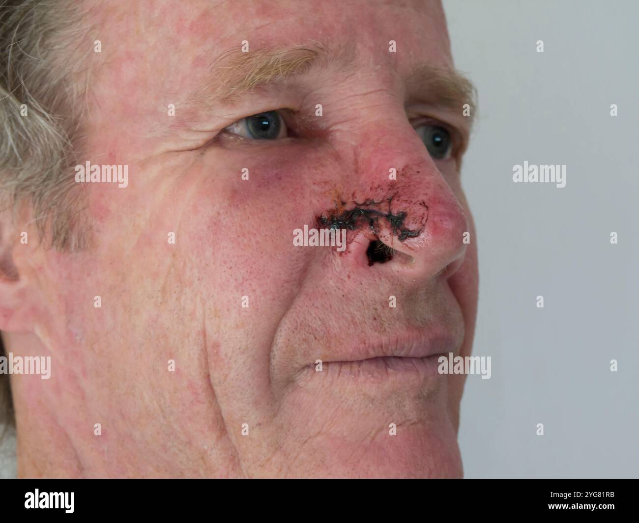 Plastisch-chirurgische BCC-Entfernung Stockfoto