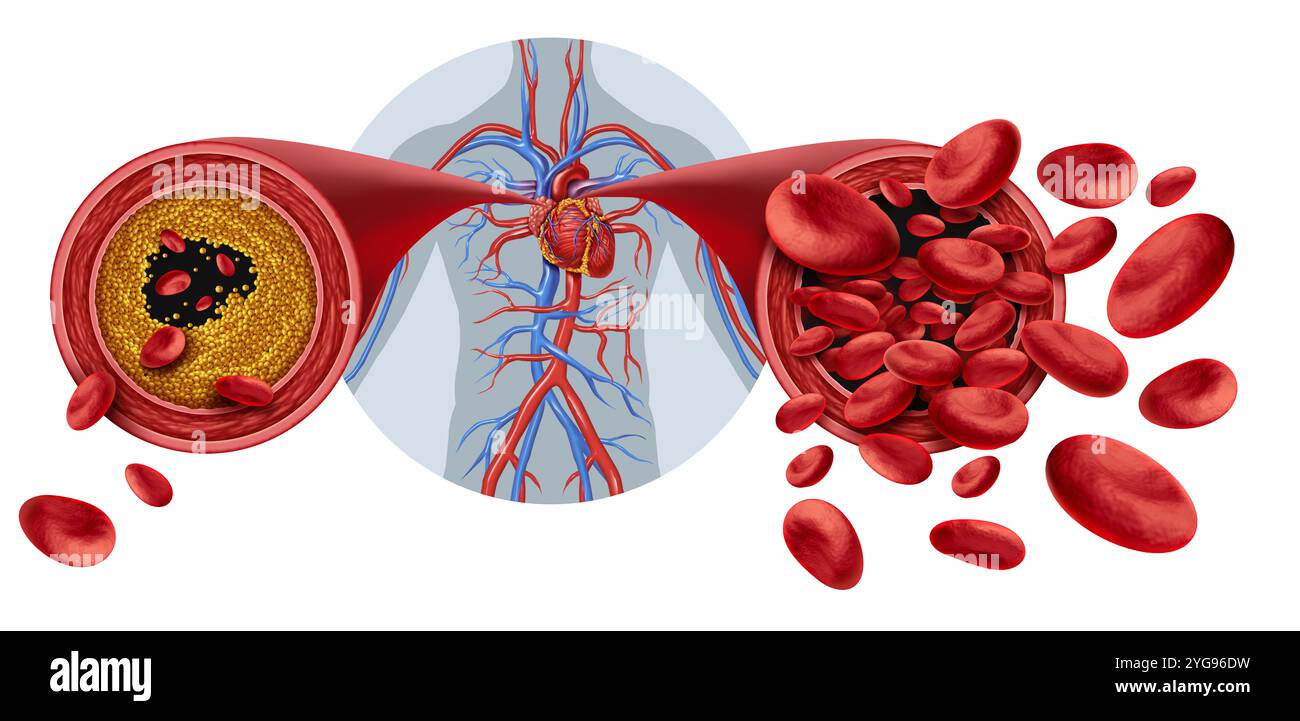 Arteriosklerose-medizinischer Zustand als blockiertes Menschenarterienkonzept und eingeschränkter Blutfluss in Arterien als Blutgefäßkrankheit mit Cholesterinfett Stockfoto