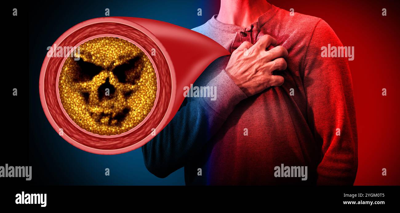 Verstopfung der Koronararterie und Brustschmerzen, die zu einem Herzinfarkt oder einem Myokardinfarkt und Atherosklerose als blockierte und eingeschränkte Arterien führen Stockfoto