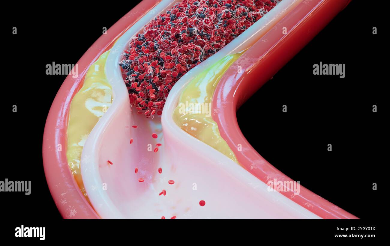 Darstellung eines Gefäßes mit Atherosklerose und Blutgerinnsel (Thrombus). Atherosklerose ist eine Verengung (Stenose) einer Arterie aufgrund von Fettablagerungen (gelb) an ihren Innenwänden. Die Ablagerungen bestehen aus Atherom, einer Substanz, die Cholesterin, zerfallende Zellen, Blutzellen und Fettproteine enthält. Die Schäden an den Wänden können auch zur Bildung eines Thrombus führen, der den Blutfluss stören kann. Ein Thrombus kann tödlich sein, wenn er den Blutfluss zu einem lebenswichtigen Organ, wie dem Gehirn, blockiert. Stockfoto