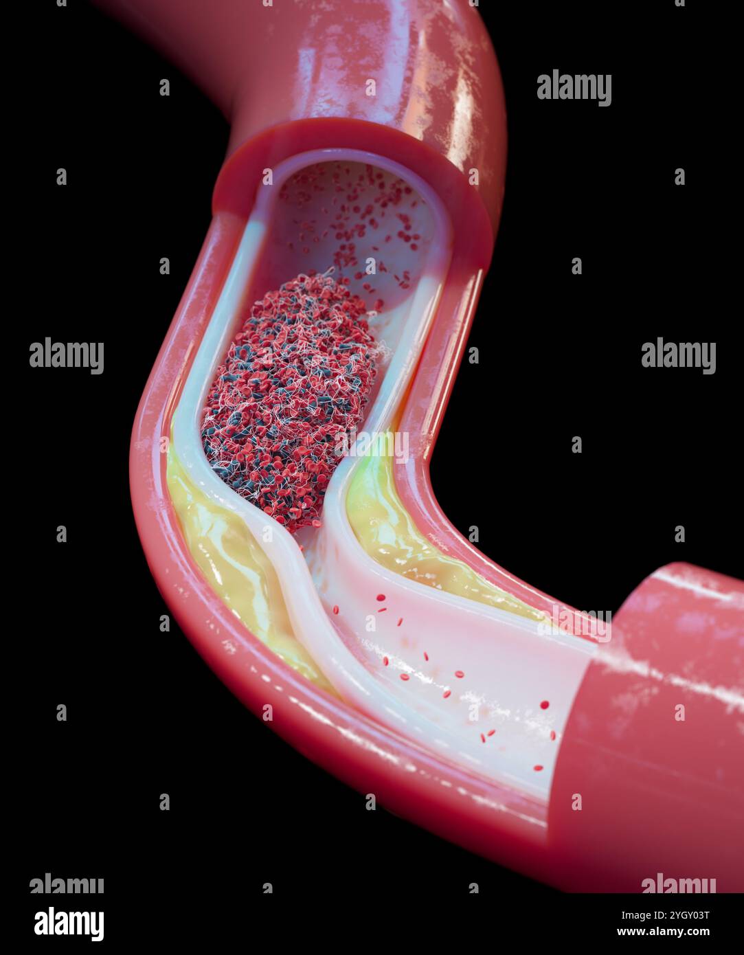 Darstellung eines Gefäßes mit Atherosklerose und Blutgerinnsel (Thrombus). Atherosklerose ist eine Verengung (Stenose) einer Arterie aufgrund von Fettablagerungen (gelb) an ihren Innenwänden. Die Ablagerungen bestehen aus Atherom, einer Substanz, die Cholesterin, zerfallende Zellen, Blutzellen und Fettproteine enthält. Die Schäden an den Wänden können auch zur Bildung eines Thrombus führen, der den Blutfluss stören kann. Ein Thrombus kann tödlich sein, wenn er den Blutfluss zu einem lebenswichtigen Organ, wie dem Gehirn, blockiert. Stockfoto