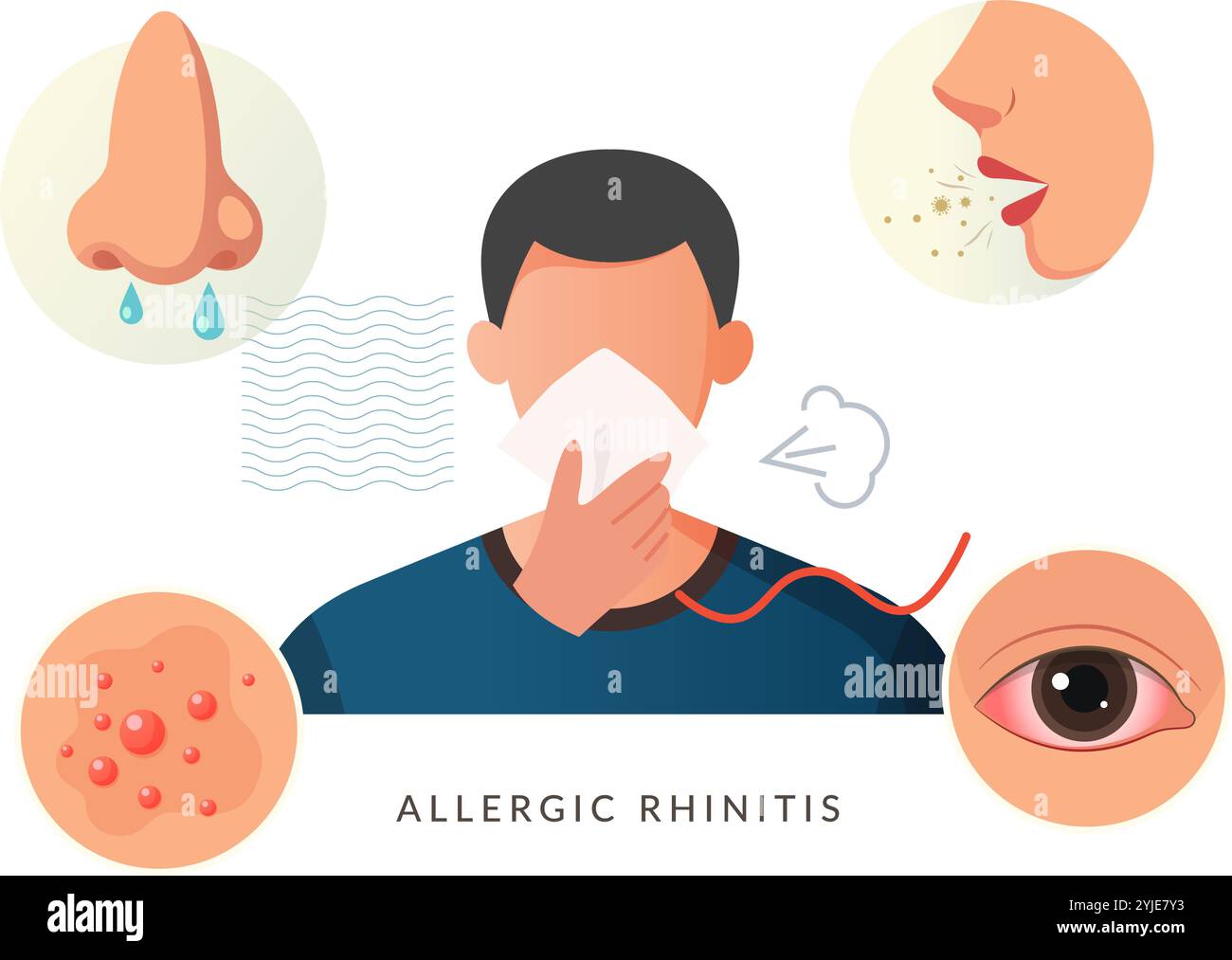 Allergische Rhinitis, auch bekannt als Heuschnupfen – Stock Illustration als EPS 10 File Stock Vektor