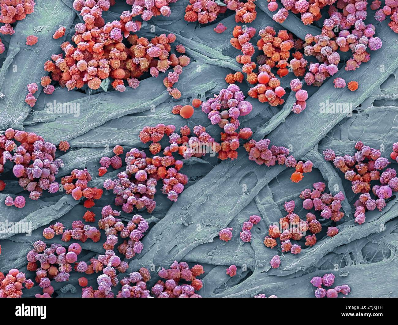 Leukämie-Blutzellen. Farbige Rasterelektronenmikrographie (REM) weißer Blutzellen eines Patienten mit chronischer lymphatischer Leukämie. Diese Krebsform tritt am häufigsten bei älteren Menschen auf und beinhaltet einen Anstieg der zirkulierenden Lymphozyten (eine Art weißer Blutkörperchen), wie hier zu sehen ist. Dies führt zu einer Verringerung des Anteils an roten Blutkörperchen, was zu Anämie und anderen Komplikationen wie einer Vergrößerung der Leber und der Milz führt. Vergrößerung: x1000 bei Druck mit einer Breite von 10 Zentimetern. Stockfoto