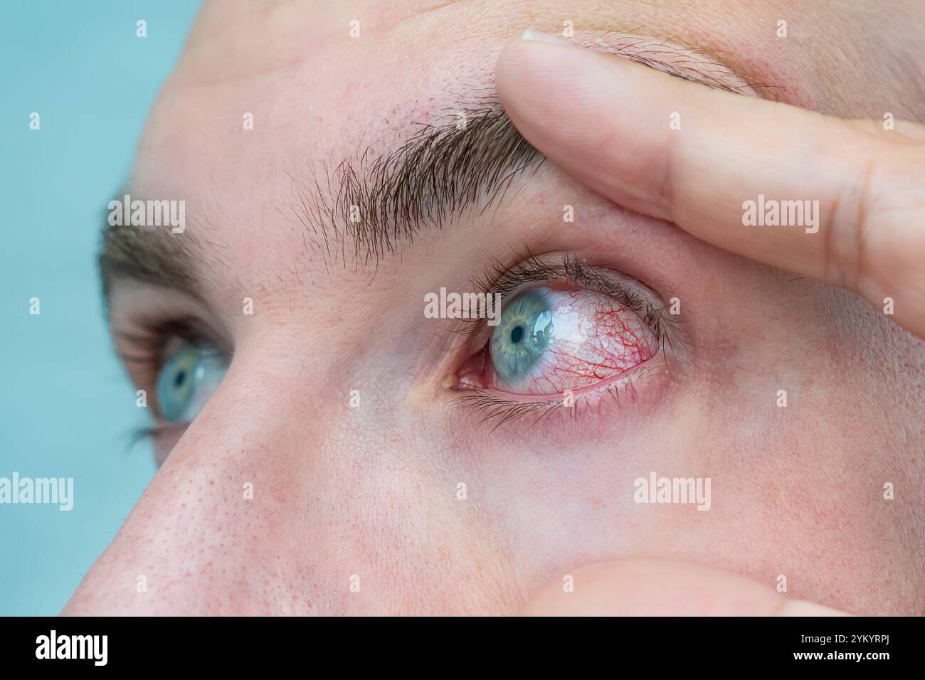 Nahaufnahme irritierter roter Augen. Mann mit rotem Auge, Makroaufnahme. Konjunktivitis-Infektion. Das Konzept der Augenkrankheit, allergische Konjunktivitis Hyper Stockfoto
