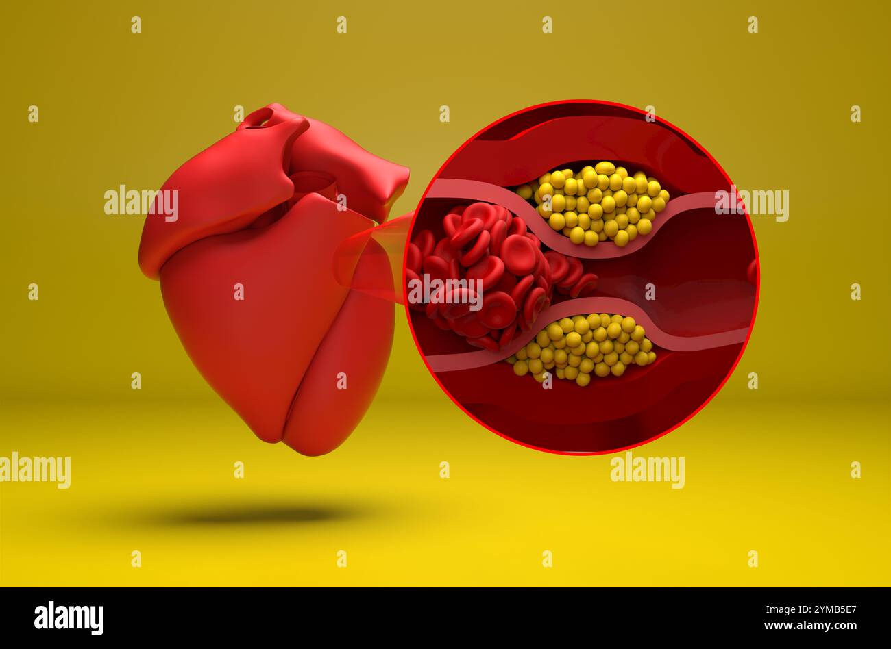 Myokardinfarkt (Herzinfarkt) - Isometrische 3D-Darstellung Stockfoto