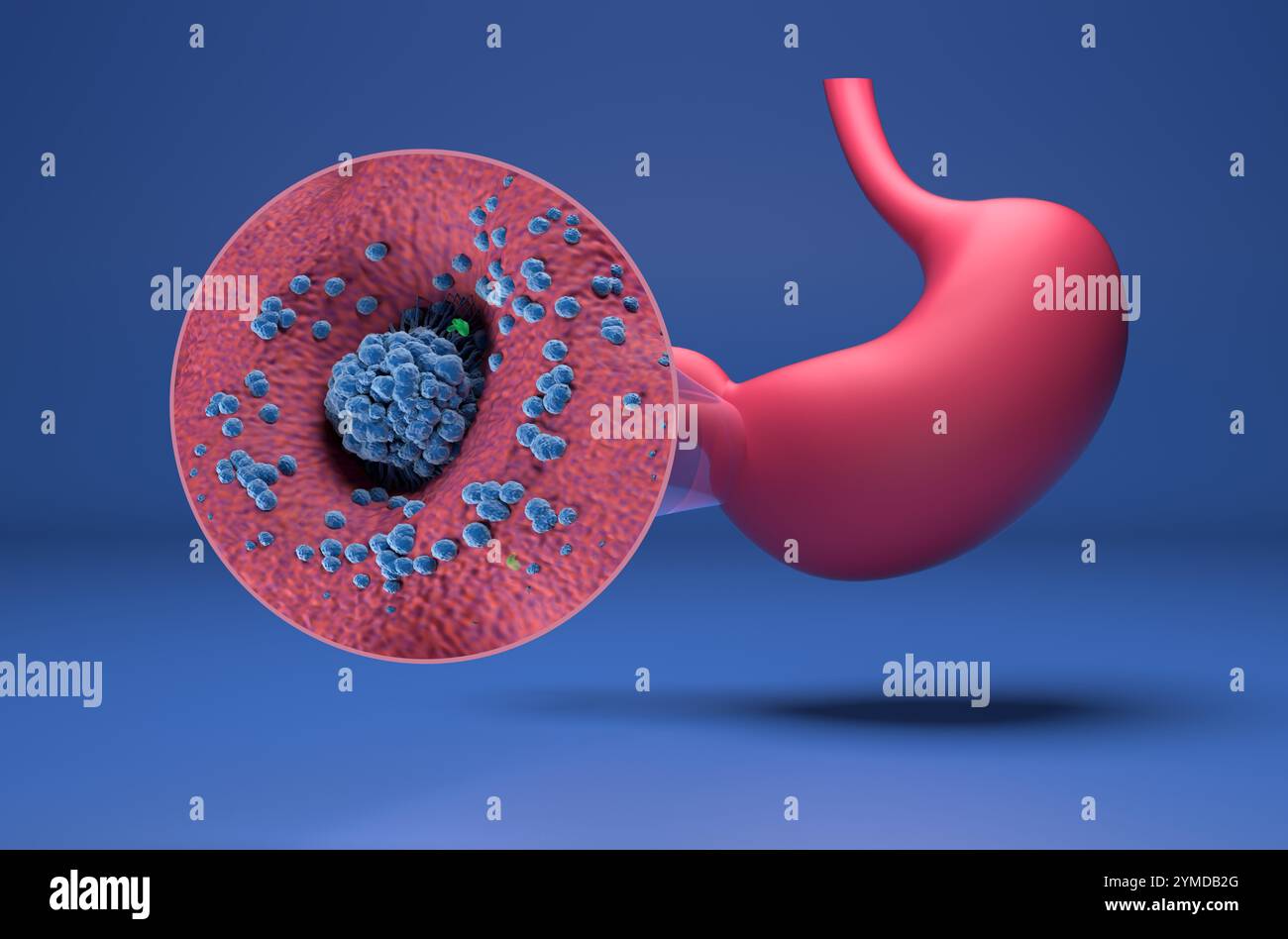 Magenkarzinom (Magen) - isometrische 3D-Darstellung Stockfoto