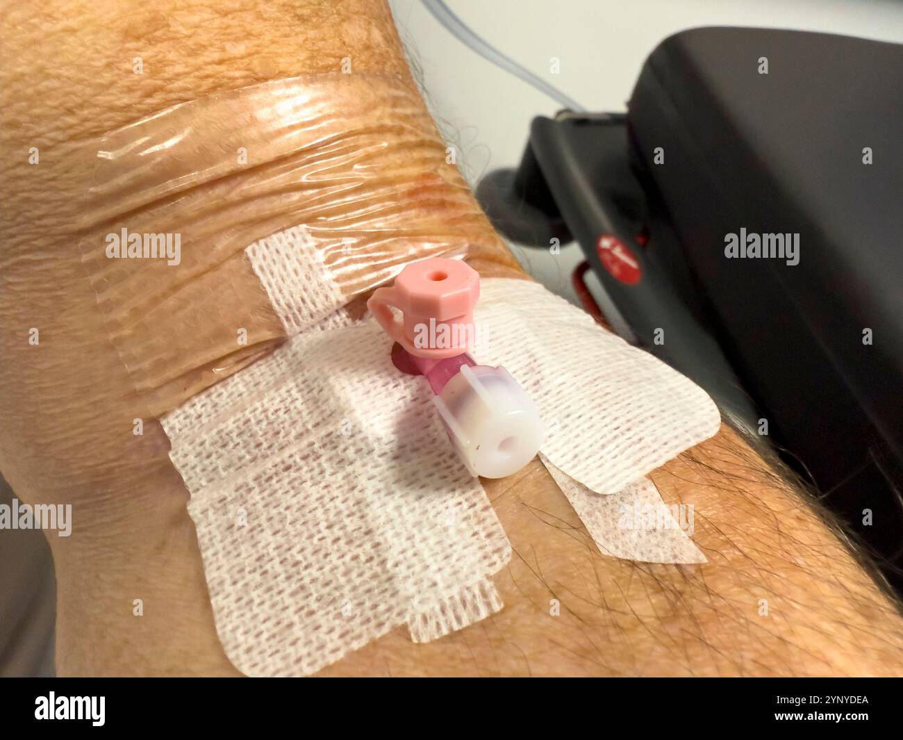Eine Kanüle, die in den Arm eines älteren Mannes eingeführt wurde: Phillip Roberts - Smartphone-aufgenommenes Stockfoto