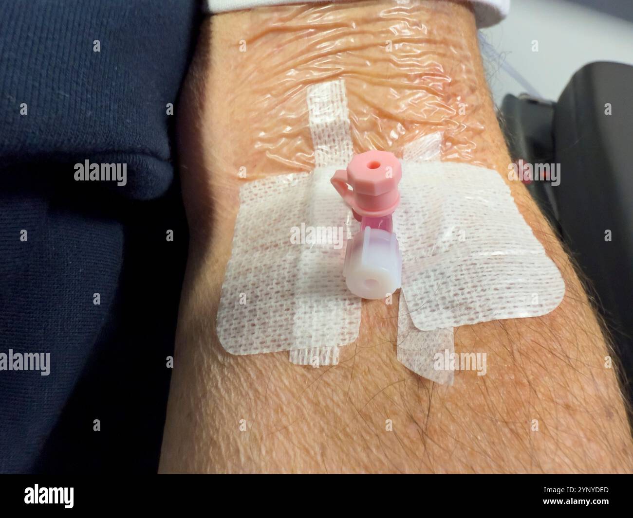 Eine Kanüle, die in den Arm eines älteren Mannes eingeführt wurde: Phillip Roberts - Smartphone-aufgenommenes Stockfoto