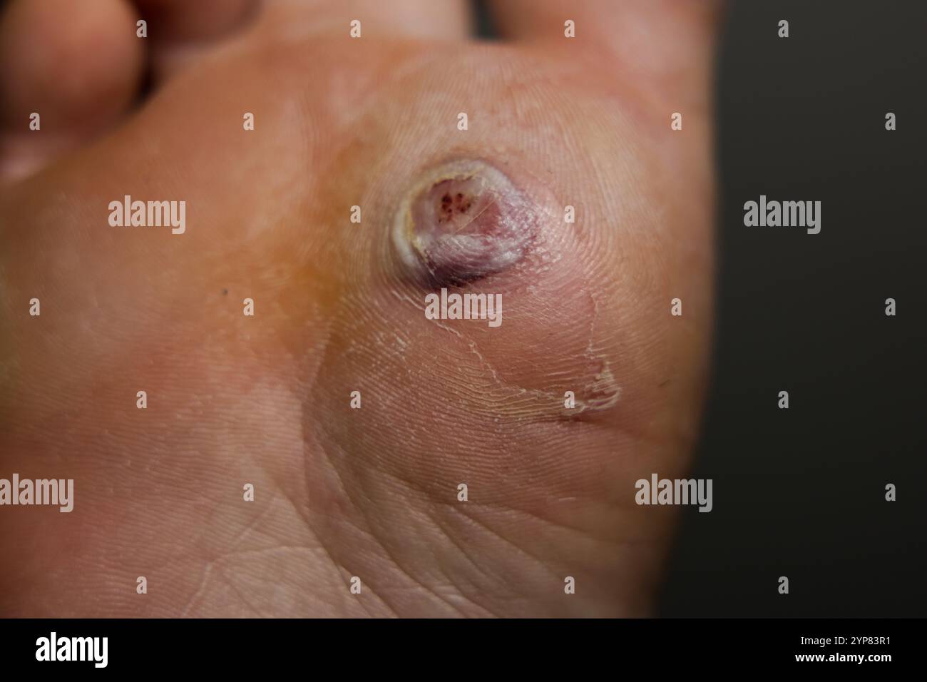 Mit Flüssigstickstoff behandelte Plantarwarzeninfektion. Blasenbildung der Plantarwarze nach Gefrierbehandlung. Stockfoto