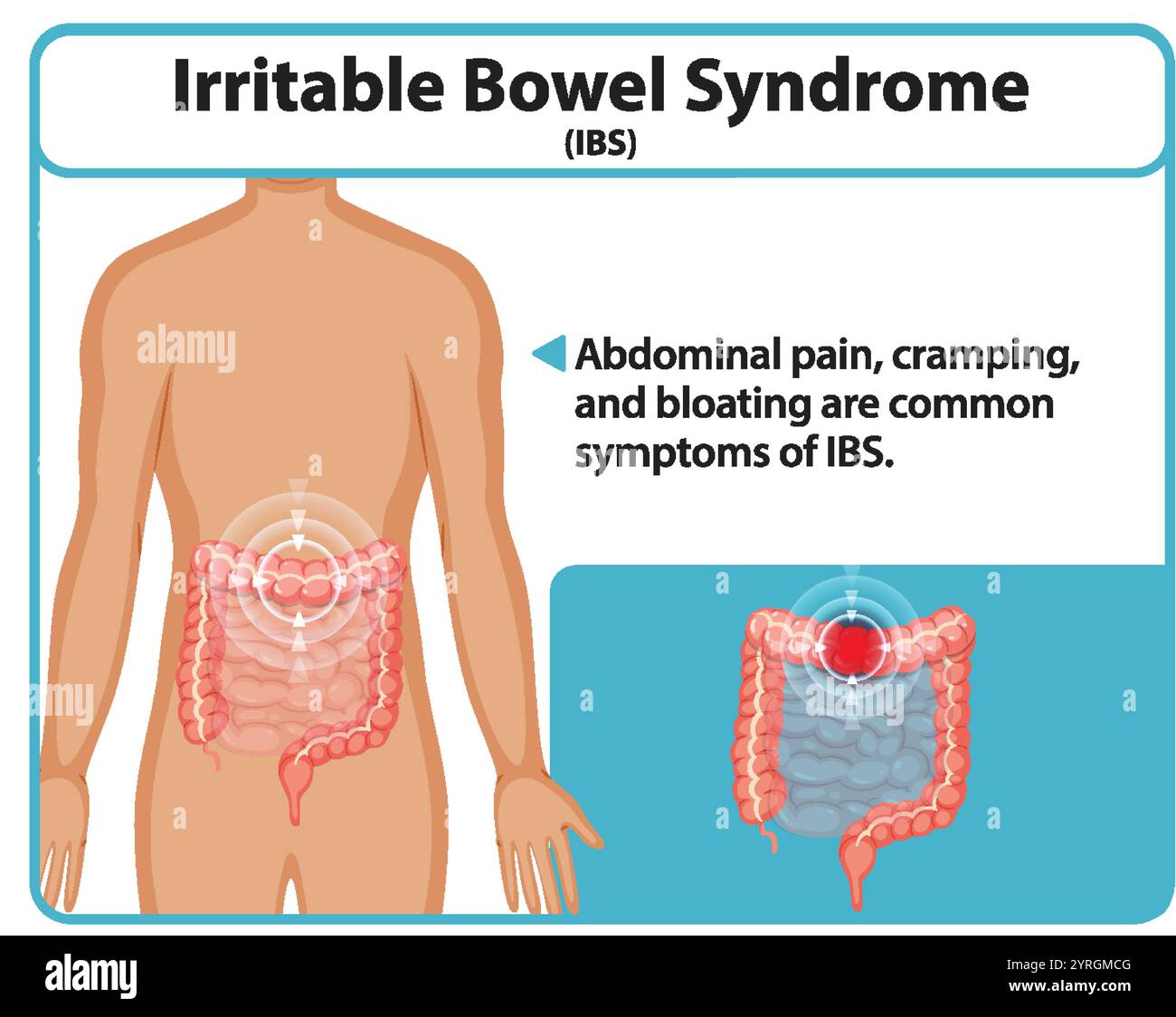 Abbildung der Symptome des RDS und der betroffenen Bereiche Stock Vektor