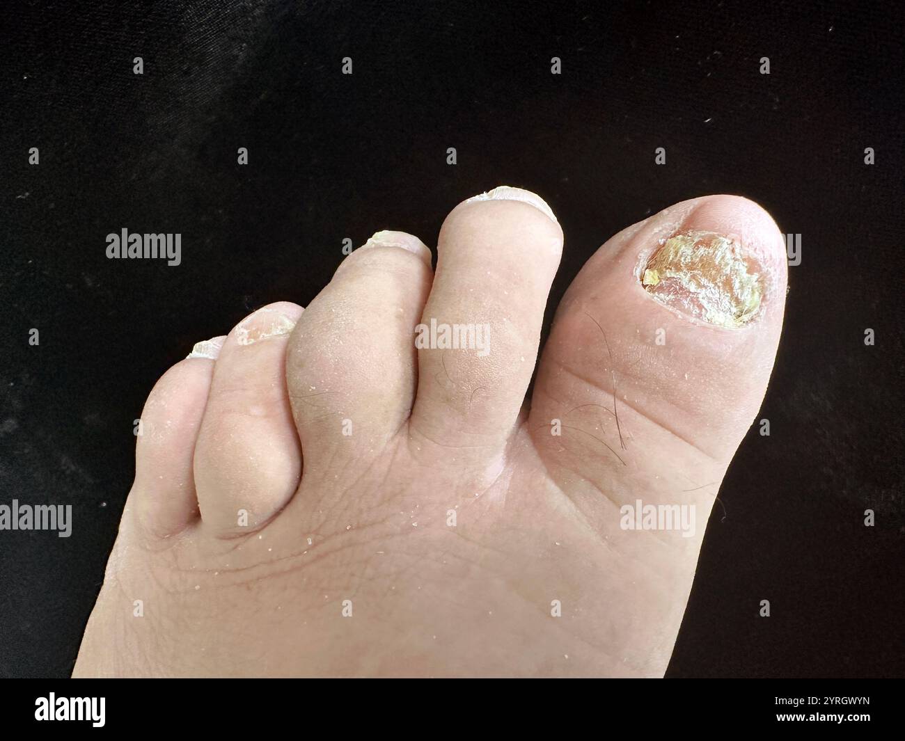 Psoriasis-Arthritis mit Schwellung der Zehen (Daktylitis) und ...