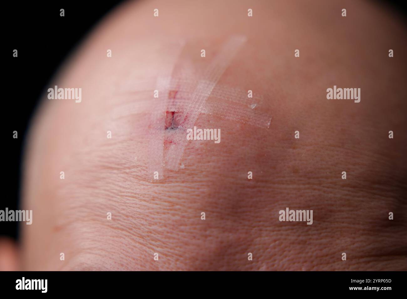 Schädeltrauma Hirnverletzung Schlagschädigung am Kopf. Großer Schnitt am Kopf durch Aufprall. Stockfoto