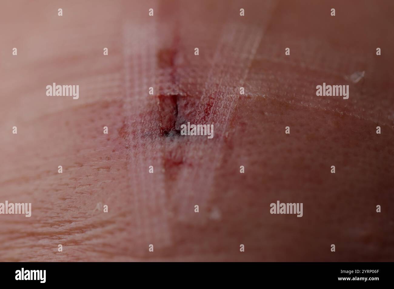 Slash-Hautschädigung Blut und Hämatom. Stockfoto