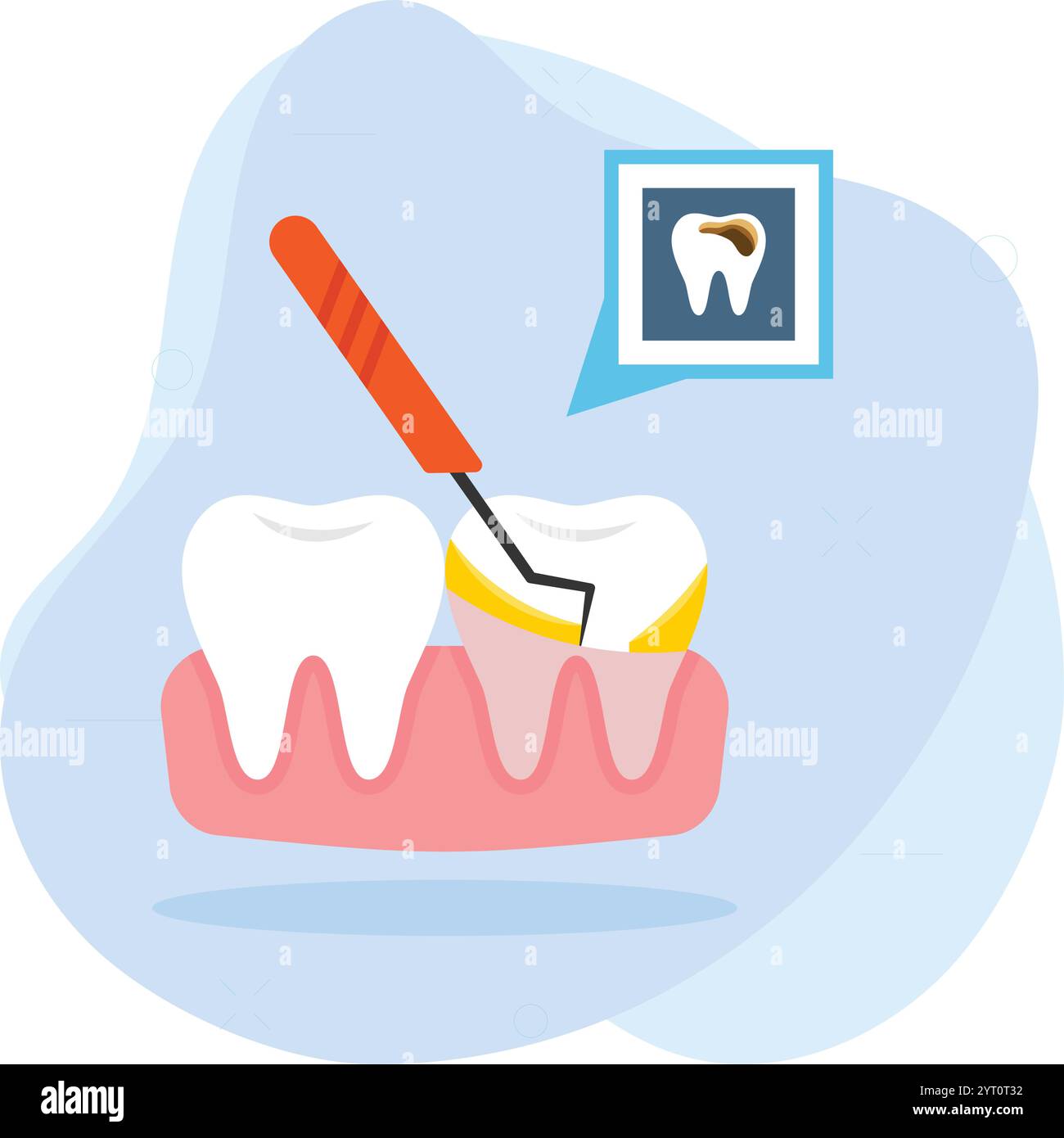 Hohlräume oder Karies Konzept, Entfernen von Stein Tartar Vektor Farbe Symbol Design, Zahnheilkunde Symbol, Healthcare Zeichen, Dental Instrument Stock, Rough Stock Vektor
