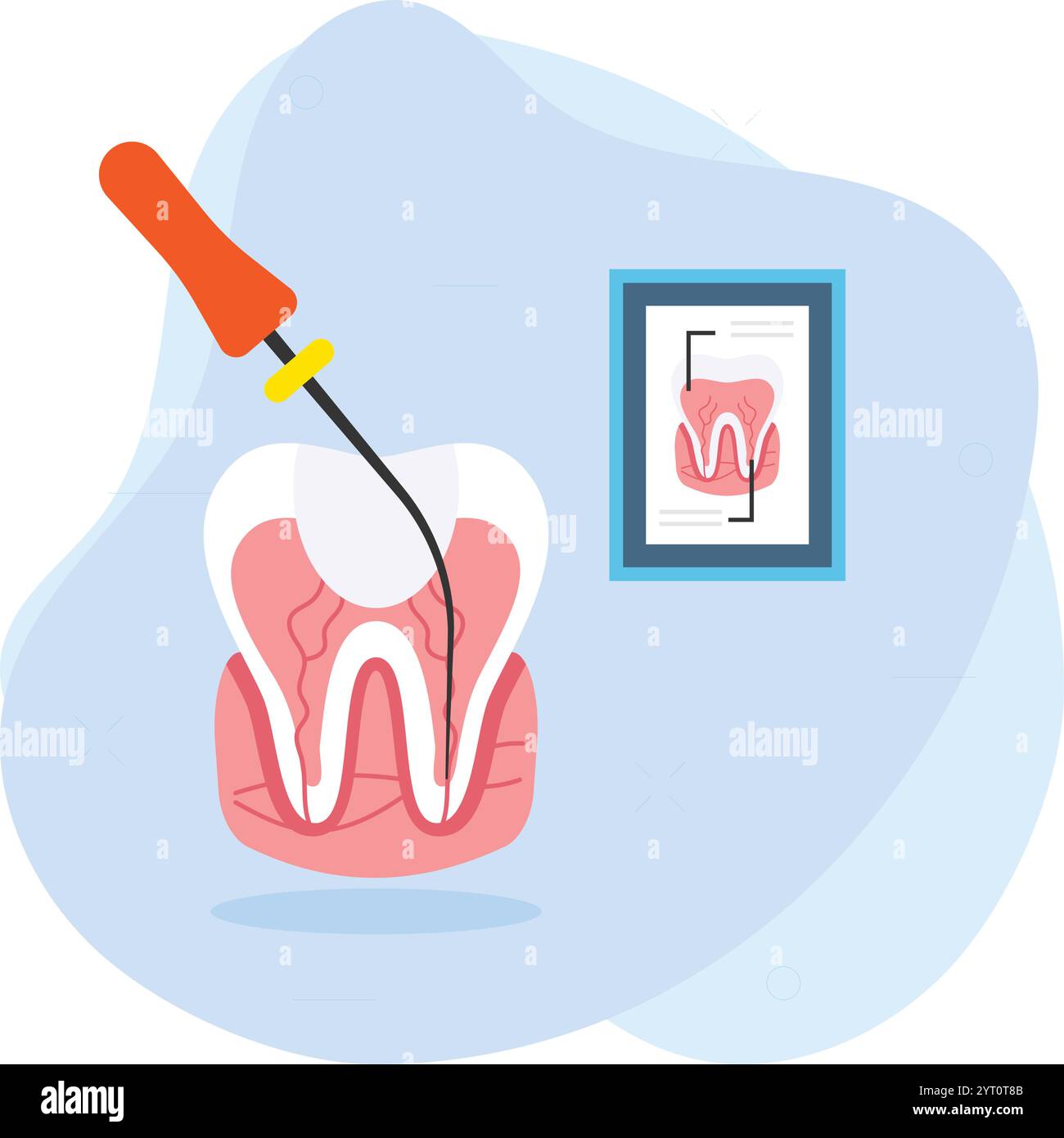 Endodontische Therapie Wurzelkanalbehandlungskonzept, Zahnuntersuchung mit Sonde und Reparatur Hohlräume Vektor Farbe Symbol Design, Zahnheilkunde Symbol, Healthc Stock Vektor