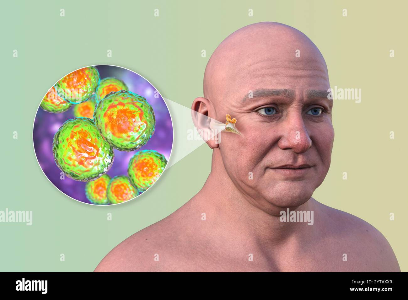 Computerdarstellung eines Mannes mit transparenter Haut, die Otitis Media (Mittelohrinfektion) und Nahaufnahme von Moraxella catarrhalis-Bakterien zeigt. Stockfoto