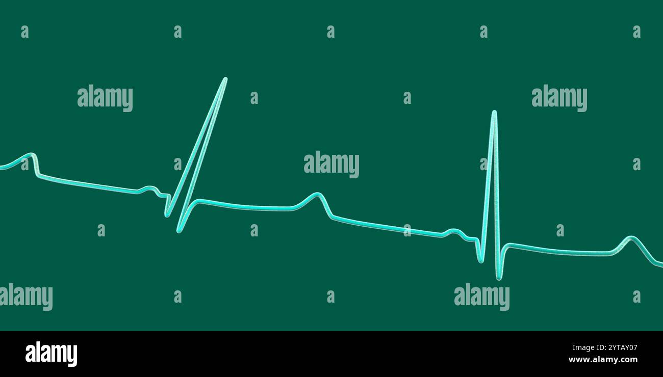 Abbildung eines Elektrokardiogramms (EKG), das T-Wellen mit spätem Auftreten zeigt, denen ein langes isoelektrisches Segment vorausgeht, charakteristisch für lange QT s vom Typ 3 Stockfoto