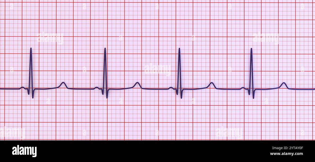 Abbildung eines Elektrokardiogramms (EKG), das T-Wellen mit spätem Auftreten zeigt, denen ein langes isoelektrisches Segment vorausgeht, charakteristisch für lange QT s vom Typ 3 Stockfoto