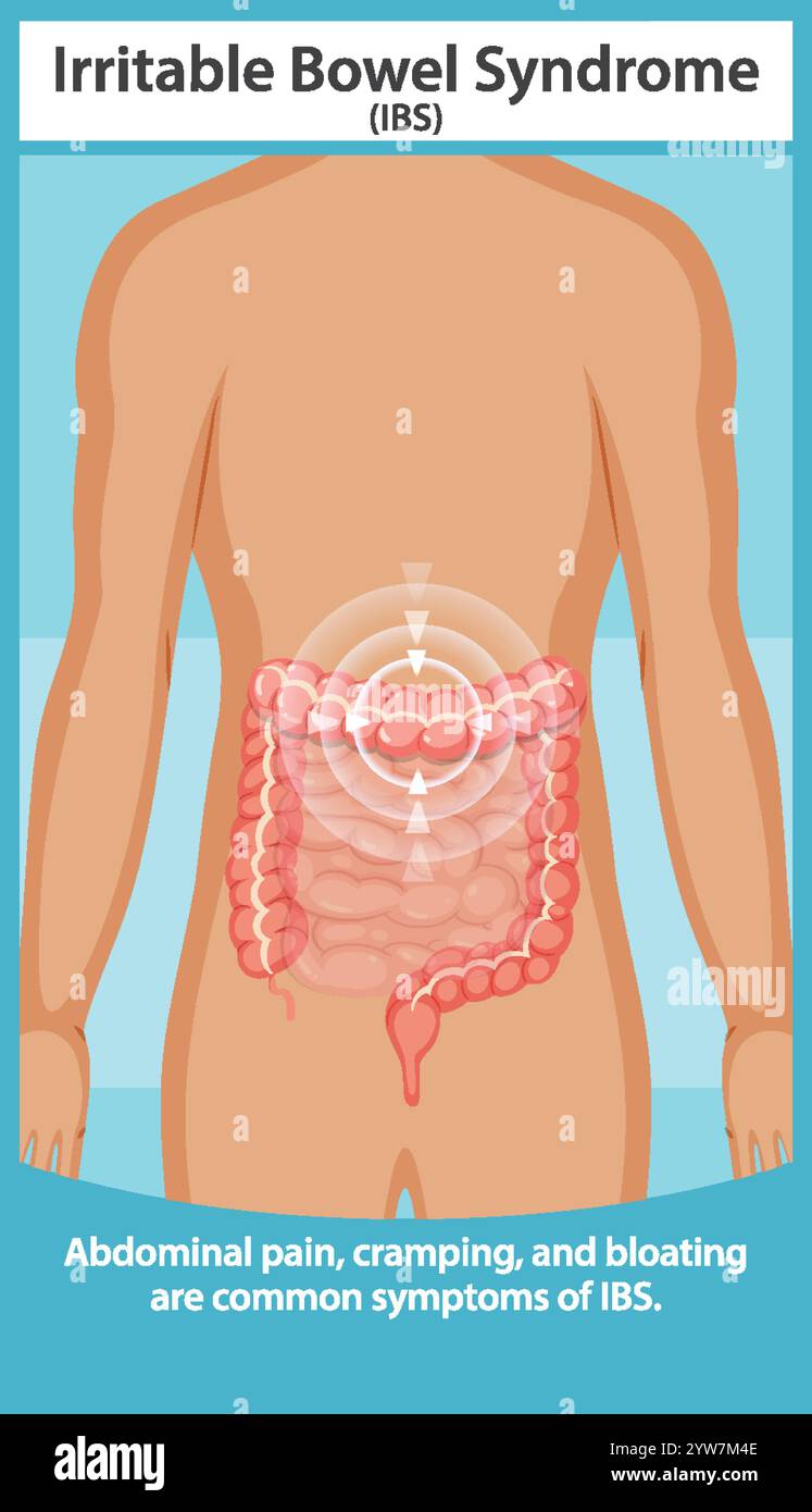 Abbildung der Symptome des RDS und der betroffenen Bereiche Stock Vektor