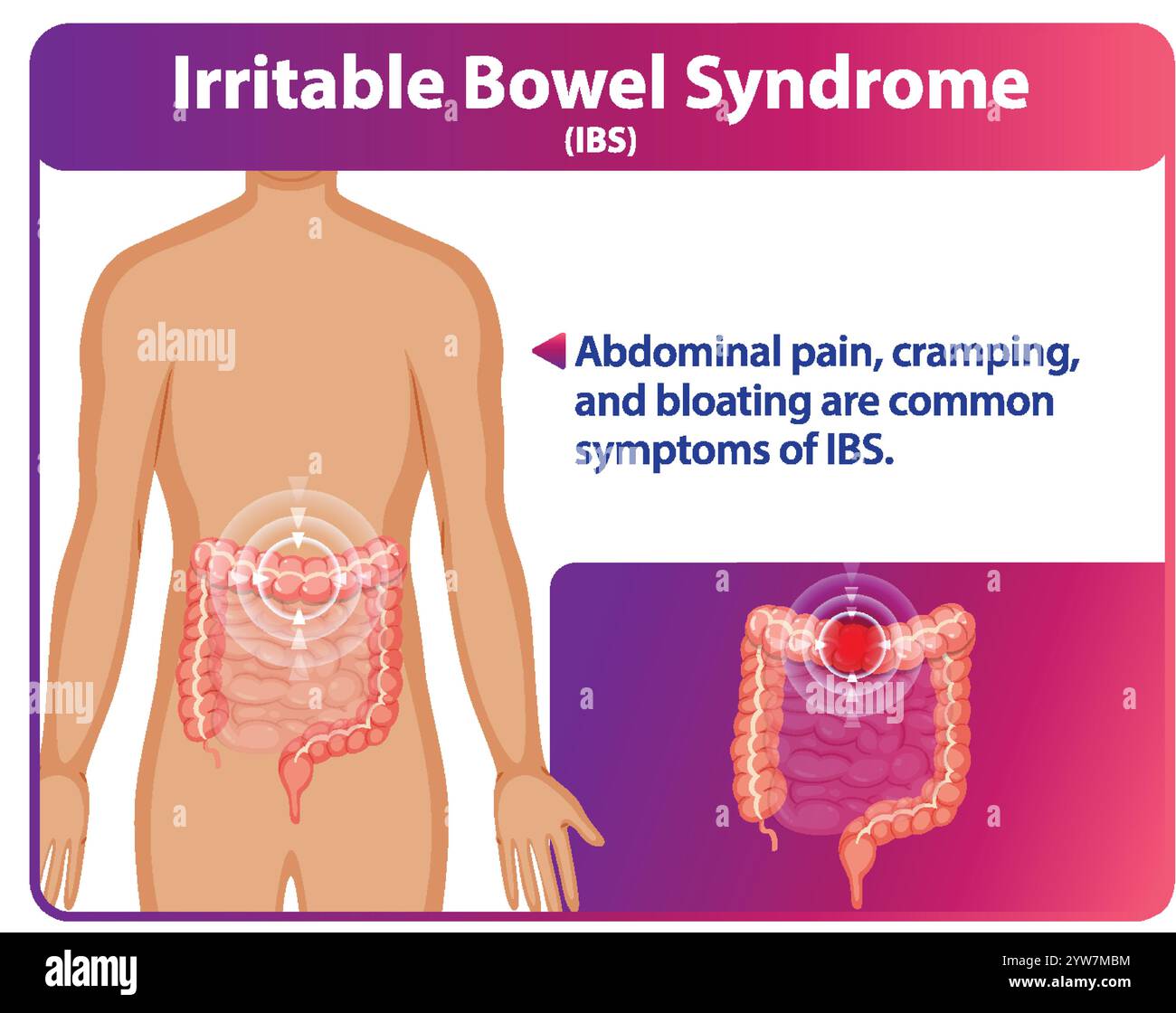 Abbildung der Symptome des RDS und der betroffenen Bereiche Stock Vektor