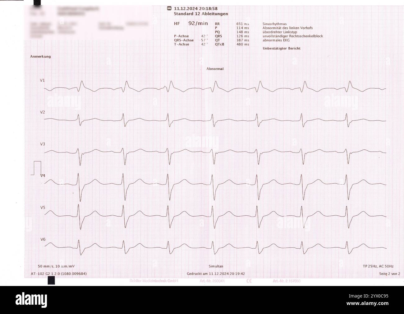 Abbild von einem EKG BEARBEITET: Ein Elektrokardiogramm EKG von einem 62-jährigen Mann zur Kontrolle der Herzfunktion. *** EKG-Bild eines 62-jährigen Mannes zur Kontrolle der Herzfunktion Stockfoto