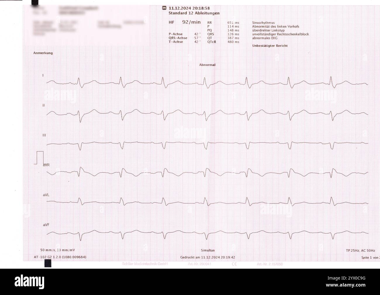 Abbild von einem EKG BEARBEITET: Ein Elektrokardiogramm EKG von einem 62-jährigen Mann zur Kontrolle der Herzfunktion. *** EKG-Bild eines 62-jährigen Mannes zur Kontrolle der Herzfunktion Stockfoto