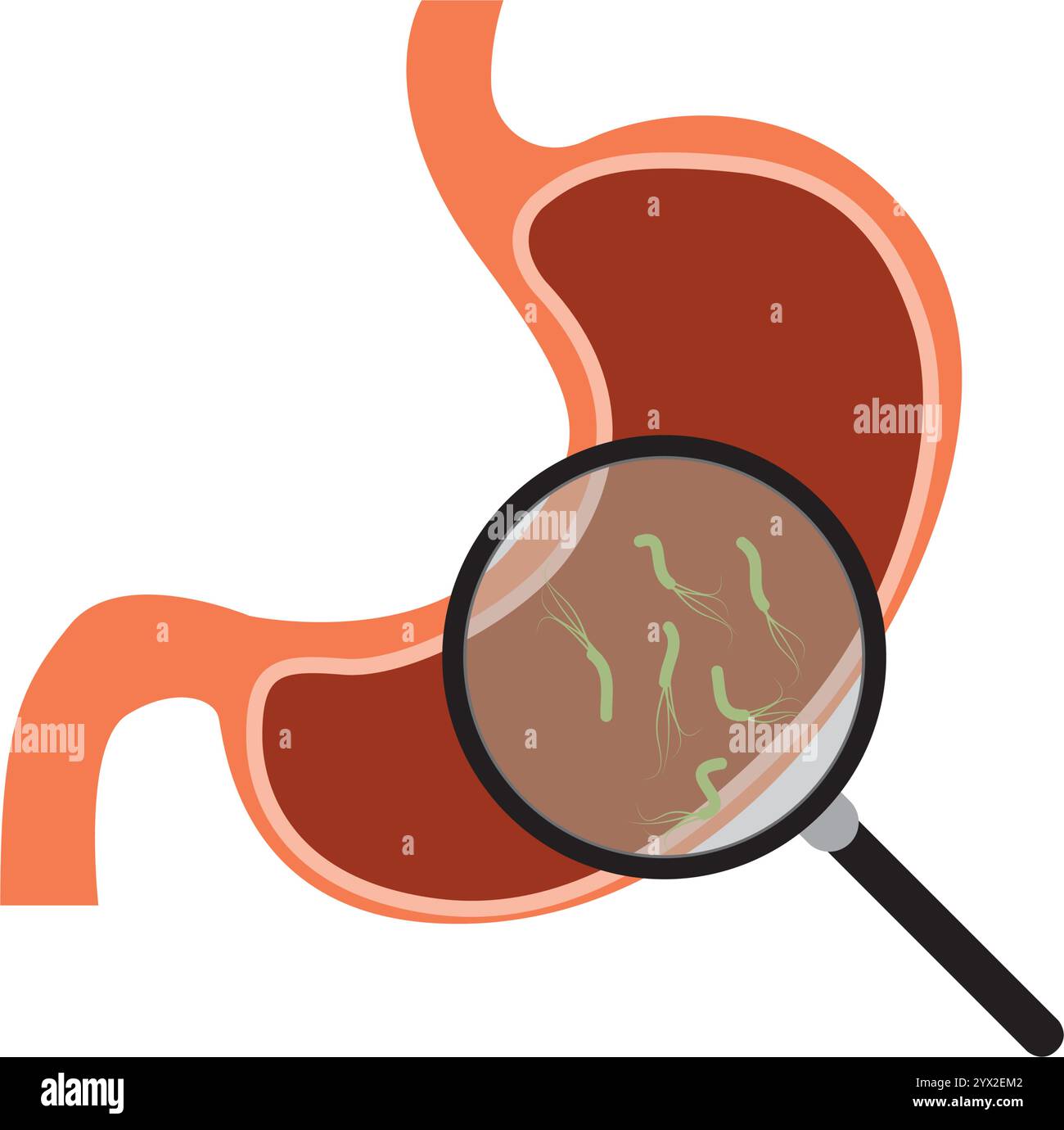 Helicobacter pylori im Magen. Magenerkrankungen. Bakterium mit Flagellen, das Gastritis verursacht. Bakterien unter Lupe. Stock Vektor