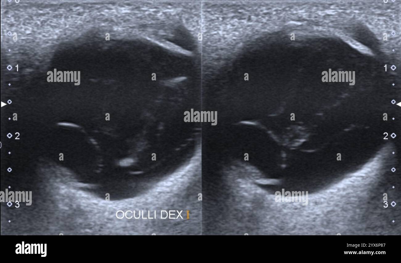 Ultraschalluntersuchung des Auges eines Patienten mit ausgelöster Linse. Die Linse kann sich aufgrund eines Traumas oder einer vorangegangenen Operation, wie z. B. einer Kataraktoperation, lösen. Die Behandlung erfolgt durch eine Operation, bei der die Linse entweder wieder angebracht oder ersetzt wird. Stockfoto